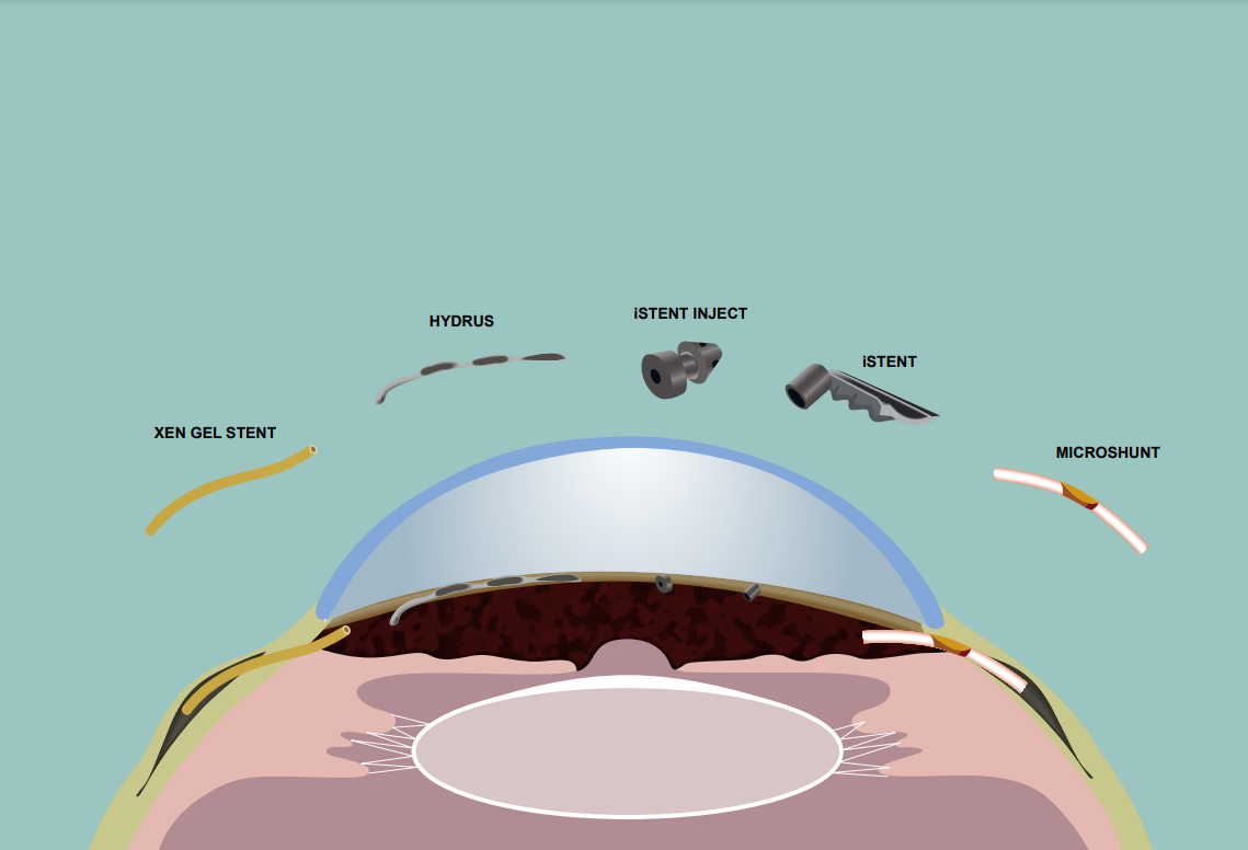 青光眼的微創手術治療